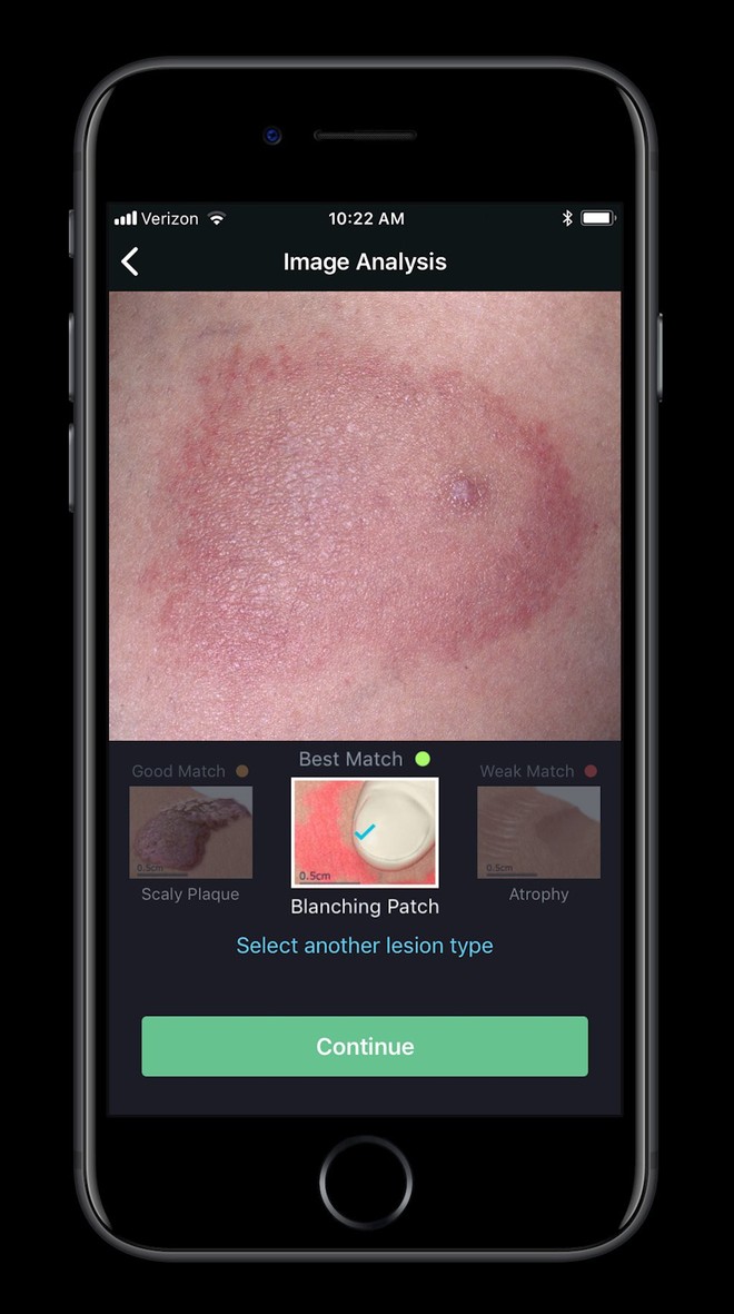 Apple cho ra đời ứng dụng giá 100 USD phát hiện bệnh da liễu thông qua ảnh chụp - Ảnh 6.