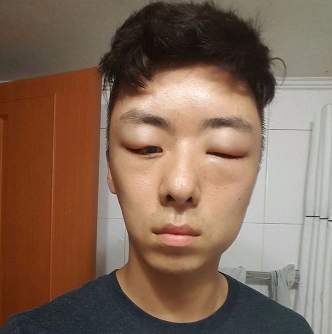 Chết cười với anh chàng Hàn Quốc bị dị ứng thuốc nhuộm tóc, đầu sưng to như quả bóng bay - Ảnh 14.