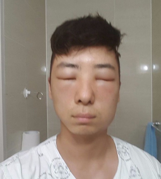 Chết cười với anh chàng Hàn Quốc bị dị ứng thuốc nhuộm tóc, đầu sưng to như quả bóng bay - Ảnh 15.