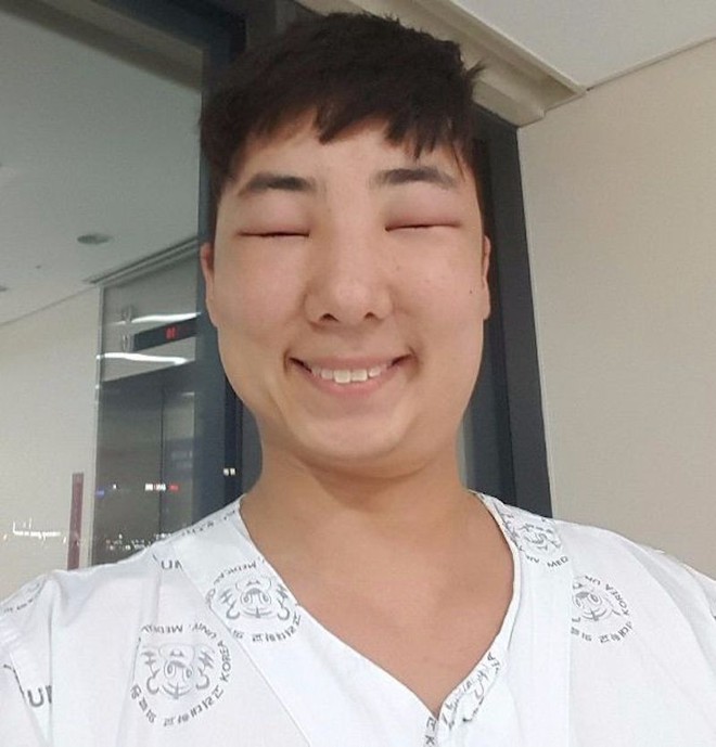 Chết cười với anh chàng Hàn Quốc bị dị ứng thuốc nhuộm tóc, đầu sưng to như quả bóng bay - Ảnh 18.