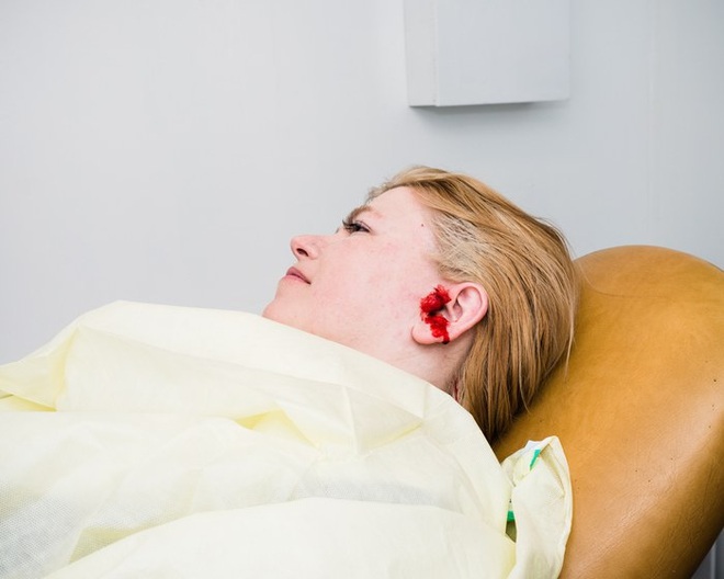  Một grinder đang nằm nghỉ ngơi sau khi phẫu thuật cấy ghép một cái nam châm vào gờ tai. 