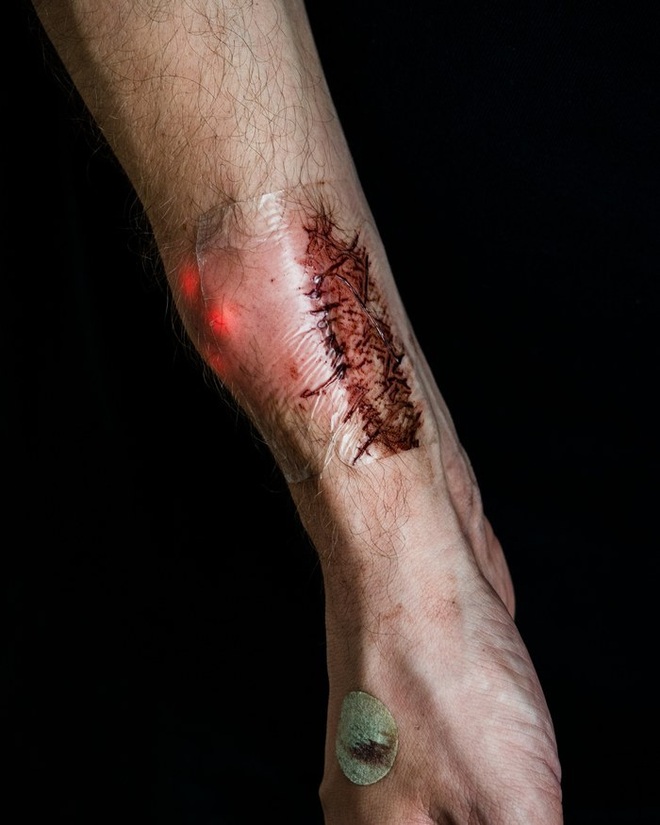  Cánh tay một người sau khi cấy ghép thiết bị mang tên “Ngôi sao phương Bắc 1.0”. 