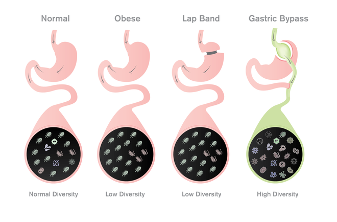  So sánh sự đa dạng của hệ vi sinh đường tiêu hóa ở người bình thường, béo phì, phẫu thuật thắt đai và nối tắt dạ dày 