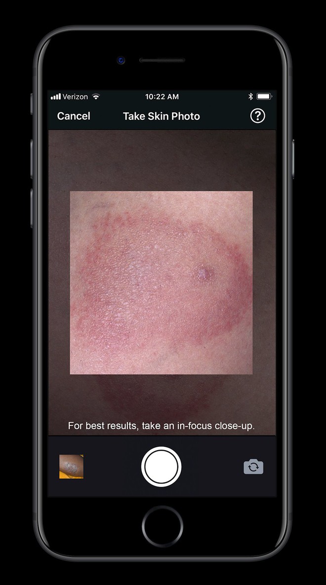 Apple cho ra đời ứng dụng giá 100 USD phát hiện bệnh da liễu thông qua ảnh chụp - Ảnh 4.