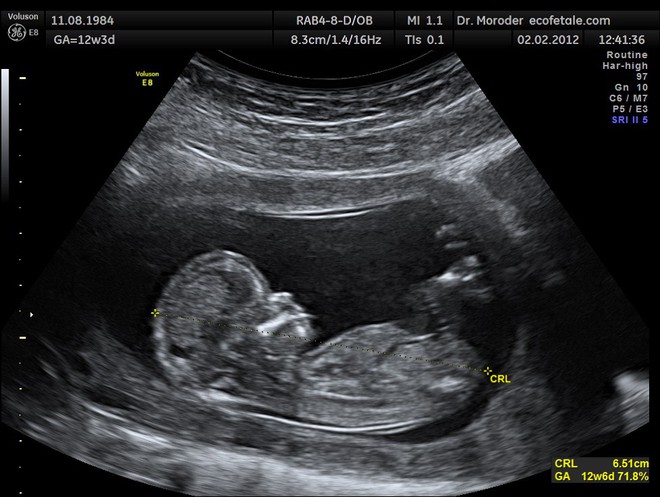  Một hình ảnh siêu âm thai nhi trong bụng mẹ 