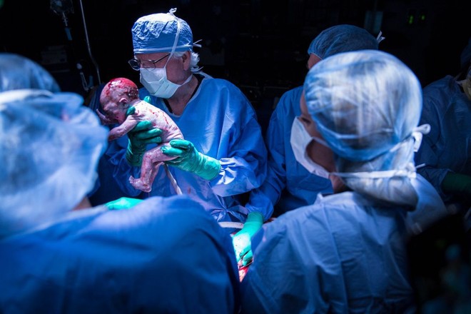  Đứa bé đầu tiên được sinh thành công từ tử cung cấy ghép tại Mỹ 