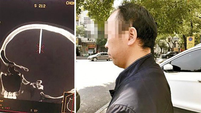Nhập viện vì đau đầu không rõ lý do, người đàn ông Trung Quốc mới biết cây đinh dài 4,8cm đã cắm vào hộp sọ - Ảnh 1.