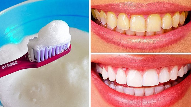 Bạn muốn tẩy trắng răng? Trước hết hãy đọc 5 lời khuyên này của nha sĩ - Ảnh 3.