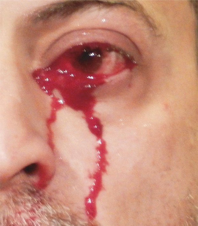 Mắc chứng bệnh kỳ lạ, người đàn ông Italia khóc ra máu khiến các bác sĩ cũng phải lúng túng - Ảnh 2.