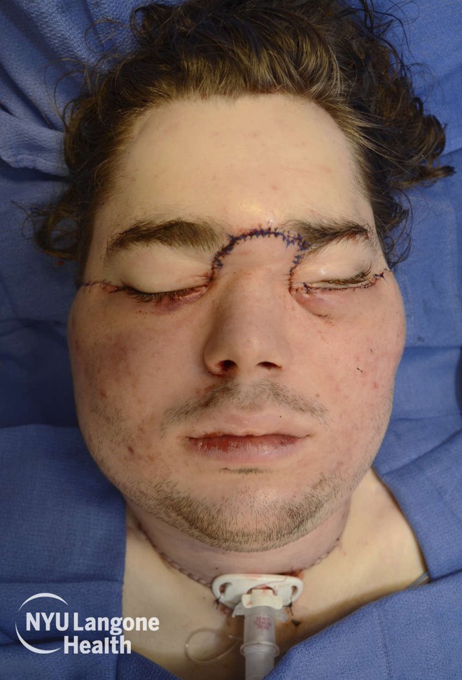 [Vietsub] Chàng thanh niên Mỹ lấy súng tự bắn vào cằm mình và hành trình hơn 1 năm đi tìm lại khuôn mặt - Ảnh 4.