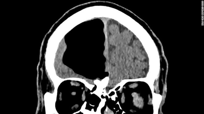  Ảnh chụp não của người đàn ông bị bệnh khí nội sọ 