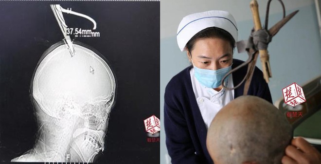 Bị chiếc kéo cắm vào đầu, người phụ nữ Trung Quốc vẫn bình tĩnh tự bắt xe bus đến bệnh viện - Ảnh 1.