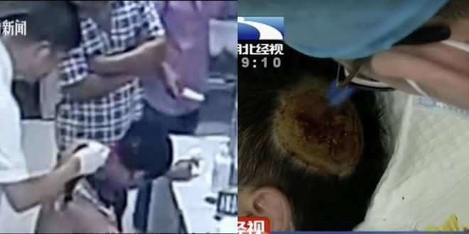 Trung Quốc: Sạc dự phòng để dưới gối bất ngờ phát nổ, thổi bay mảng da đầu của người đàn ông đang ngủ - Ảnh 2.