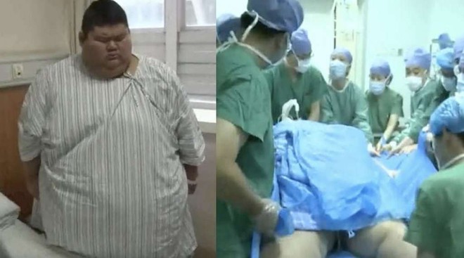 Trung Quốc: Cắt bỏ 4/5 dạ dày để giảm cân, chàng béo 334kg quyết tâm trở thành huấn luyện viên thể hình - Ảnh 2.