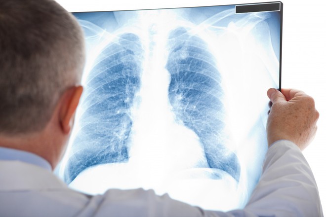  Chụp X-quang có thể phát hiện ung thư phổi, nhưng thường đã ở giai đoạn muộn 