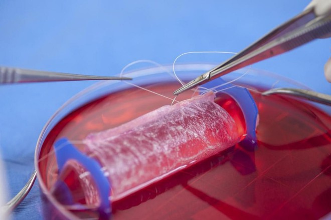  Một âm đạo được nuôi từ tế bào trong phòng thí nghiệm của bác sĩ Atala 