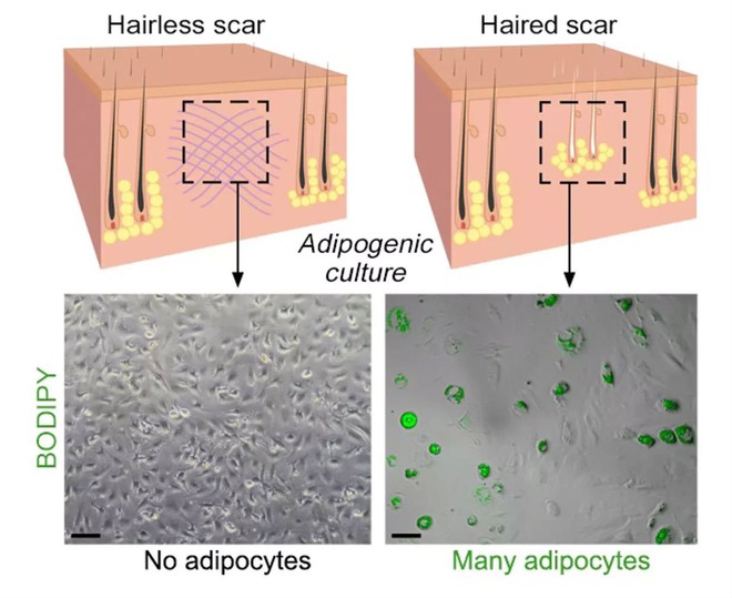  Các nhà khoa học phát hiện cấy nang lông vào vết thương có thể là một cách để ngăn sẹo 