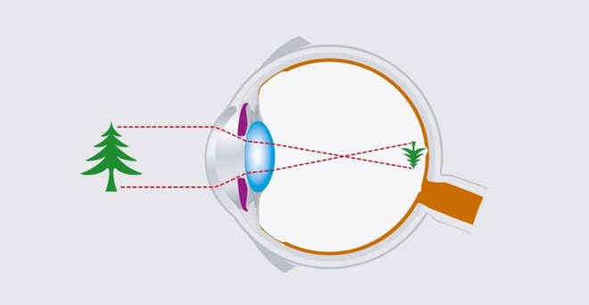 Báo cáo WHO: 40% nhân loại sẽ bị cận thị vào năm 2030, phụ huynh nên cho trẻ ra ngoài trời ít nhất 1 tiếng mỗi ngày - Ảnh 2.