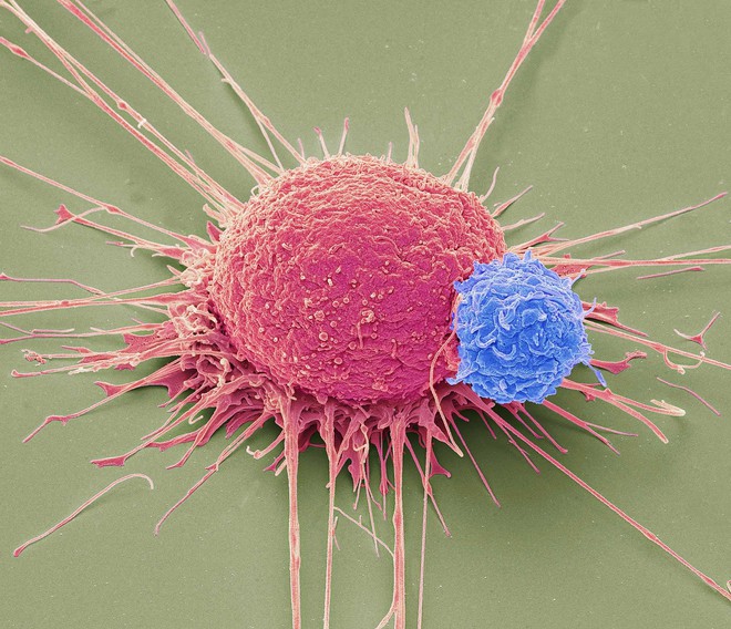 Tiêm vi khuẩn vào khối u để giết chết ung thư: Thử nghiệm cho kết quả đầy hứa hẹn - Ảnh 3.