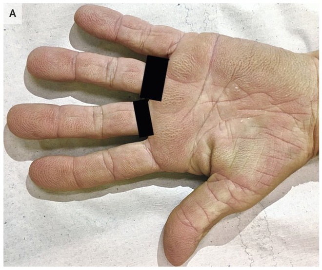 Dấu hiệu vân nhăn kỳ lạ trong lòng bàn tay thể hiện nguy cơ bệnh ung thư tiềm ẩn - Ảnh 1.