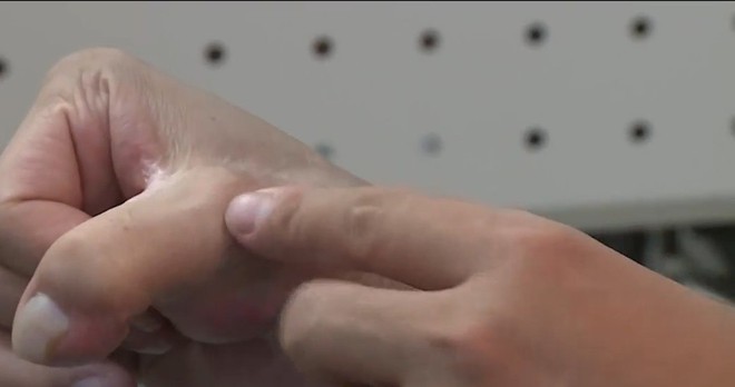 Việt Nam thực hiện thành công phẫu thuật siêu khó tầm cỡ quốc tế: lấy ngón CHÂN cái thay cho ngón TAY cái để phục hồi chức năng bàn tay! - Ảnh 10.