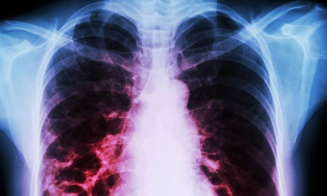 Mỹ: Phát hiện gần 100 ca bệnh phổi bí ẩn liên quan đến thuốc lá điện tử - Ảnh 2.