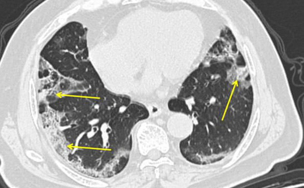 Không giống viêm phổi thông thường: Điều gì xảy ra với phổi của bệnh nhân nhiễm COVID-19? - Ảnh 1.