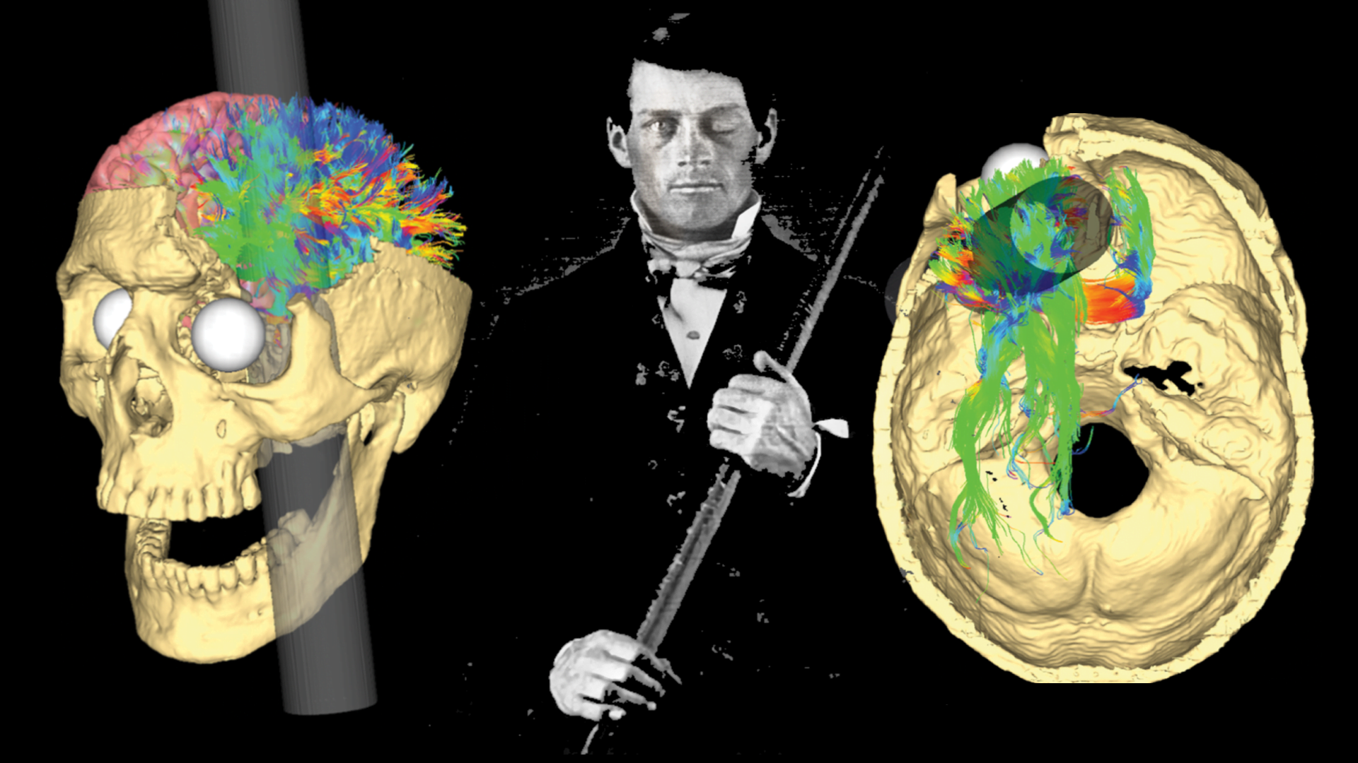 why is phineas gage a case study