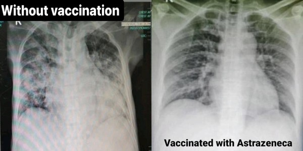 4 bức ảnh chụp phổi của bệnh nhân Covid-19 đã tiêm các loại vắc ...