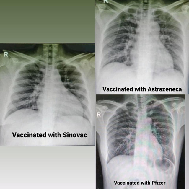 4 bức ảnh chụp phổi của bệnh nhân Covid-19 đã tiêm các loại vắc xin khác nhau và không tiêm: Kết quả gây sốc! - Ảnh 2.