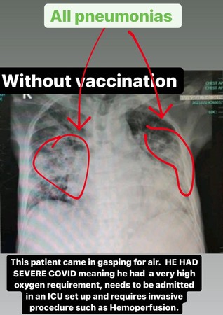 4 bức ảnh chụp phổi của bệnh nhân Covid-19 đã tiêm các loại vắc xin khác nhau và không tiêm: Kết quả gây sốc! - Ảnh 3.