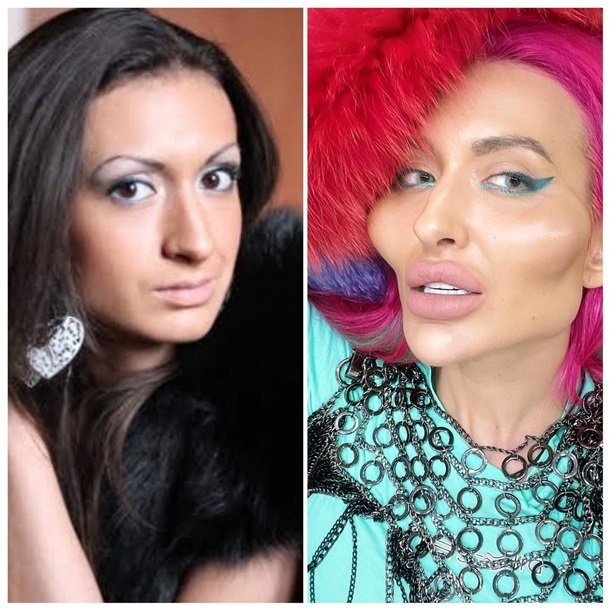 Chi 52 triệu đồng để sửa gò má và bơm môi, cô gái Ukraine đã biến đổi khuôn mặt mình như thế nào? - Ảnh 2.