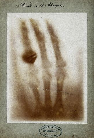 First_medical_X-ray_by_Wilhelm_Röntgen_of_his_wife_Anna_Bertha_Ludwig's_hand _-_ 18951222.jpg