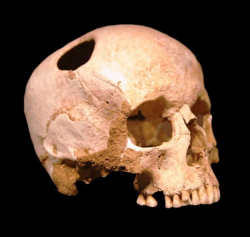 Trepanation: Thủ tục phẫu thuật sọ lâu đời nhất thế giới vẫn tồn tại đến ngày nay!- Ảnh 4.