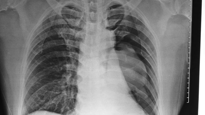 lung-scan-xray.jpg