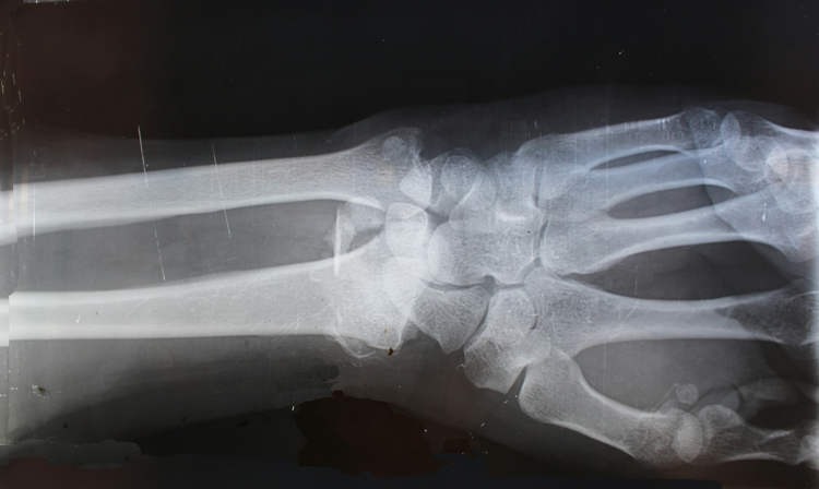 Bone-02, loại 'keo siêu dính' có thể chữa lành xương gãy chỉ trong vài phút- Ảnh 4. Bone-02, loại 'keo siêu dính' có thể chữa lành xương gãy chỉ trong vài phút- Ảnh 4.