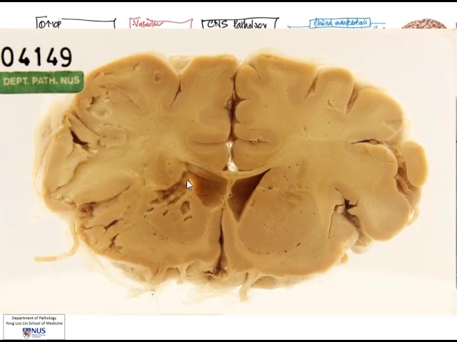 Cảnh giác trước Prion: Một căn bệnh "zombie" có khả năng lây nhiễm loài người- Ảnh 7.