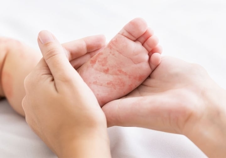 Bé gái 4 tuổi ở Hà Nội tử vong do mắc sởi- Ảnh 1. Bé gái 4 tuổi ở Hà Nội tử vong do mắc sởi- Ảnh 1.