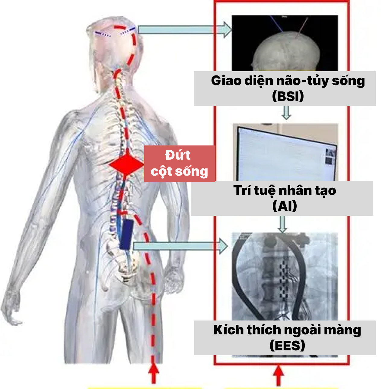 Trung Quốc phát triển công nghệ 3 trong 1 giúp người liệt đầu tiên đứng dậy đi lại được- Ảnh 2.