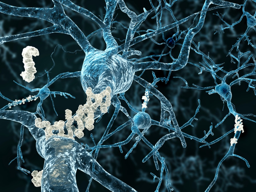 Alzheimer có thể bắt đầu từ một đoạn gene duy nhất - và AI vừa lần ra manh mối ấy- Ảnh 1. Alzheimer có thể bắt đầu từ một đoạn gene duy nhất - và AI vừa lần ra manh mối ấy- Ảnh 1.
