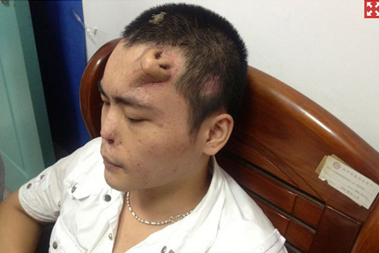 Không phải ảnh lỗi của AI, người đàn ông này đã thực sự mọc một chiếc mũi trên trán: Đó là "tác phẩm" của các bác sĩ Trung Quốc- Ảnh 2. Không phải ảnh lỗi của AI, người đàn ông này đã thực sự mọc một chiếc mũi trên trán: Đó là "tác phẩm" của các bác sĩ Trung Quốc- Ảnh 2.