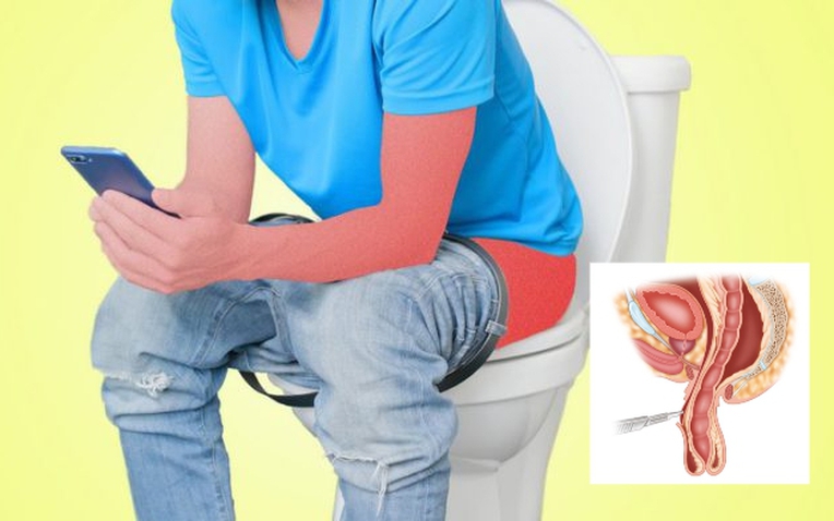 Sa 13 cm ruột ra ngoài vì ngồi toilet ôm điện thoại suốt 2 tiếng- Ảnh 1. Sa 13 cm ruột ra ngoài vì ngồi toilet ôm điện thoại suốt 2 tiếng- Ảnh 1.