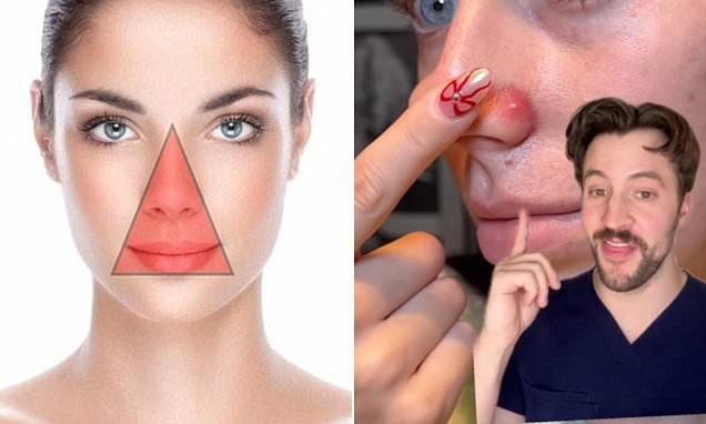 Nữ sinh 15 tuổi ở Hà Nội tử vong sau nặn mụn: Có một "tam giác tử thần" trên mặt mà bạn tuyệt đối không nên động vào- Ảnh 4. Nữ sinh 15 tuổi ở Hà Nội tử vong sau nặn mụn: Có một "tam giác tử thần" trên mặt mà bạn tuyệt đối không nên động vào- Ảnh 4.