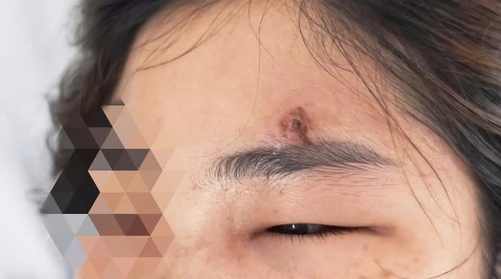 Nữ sinh 15 tuổi ở Hà Nội tử vong sau nặn mụn: Có một "tam giác tử thần" trên mặt mà bạn tuyệt đối không nên động vào- Ảnh 6. Nữ sinh 15 tuổi ở Hà Nội tử vong sau nặn mụn: Có một "tam giác tử thần" trên mặt mà bạn tuyệt đối không nên động vào- Ảnh 6.