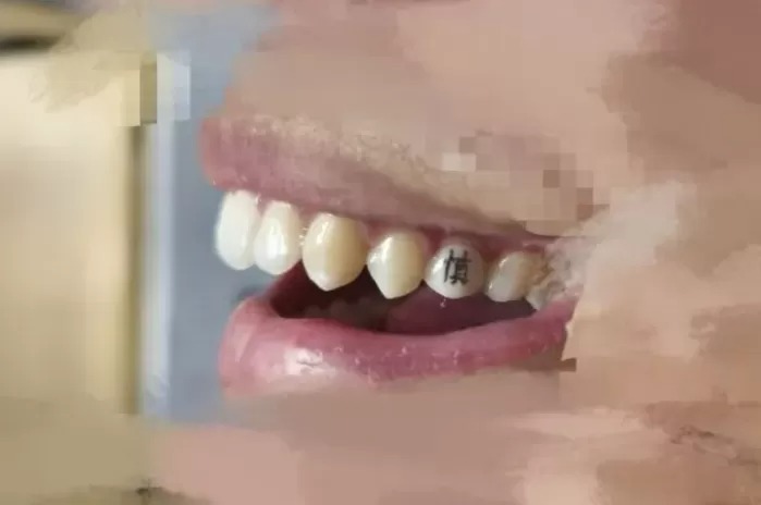 Chán hình xăm trên da, giới trẻ Trung Quốc chuyển sang xăm răng- Ảnh 2.
