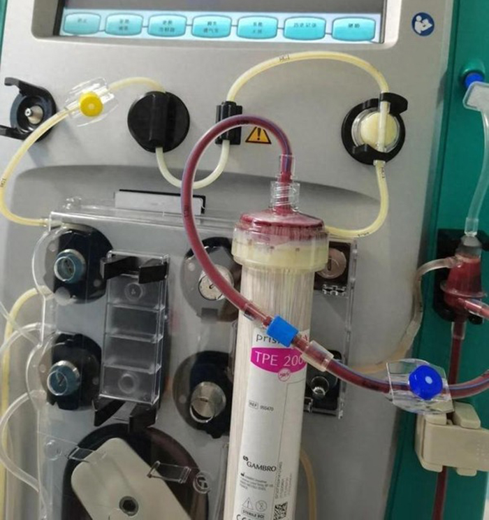 Chàng trai 19 tuổi máu đục như sữa, suy đa tạng nguy kịch vì 2 kiểu LƯỜI người trẻ thường mắc phải- Ảnh 2. Chàng trai 19 tuổi máu đục như sữa, suy đa tạng nguy kịch vì 2 kiểu LƯỜI người trẻ thường mắc phải- Ảnh 2.
