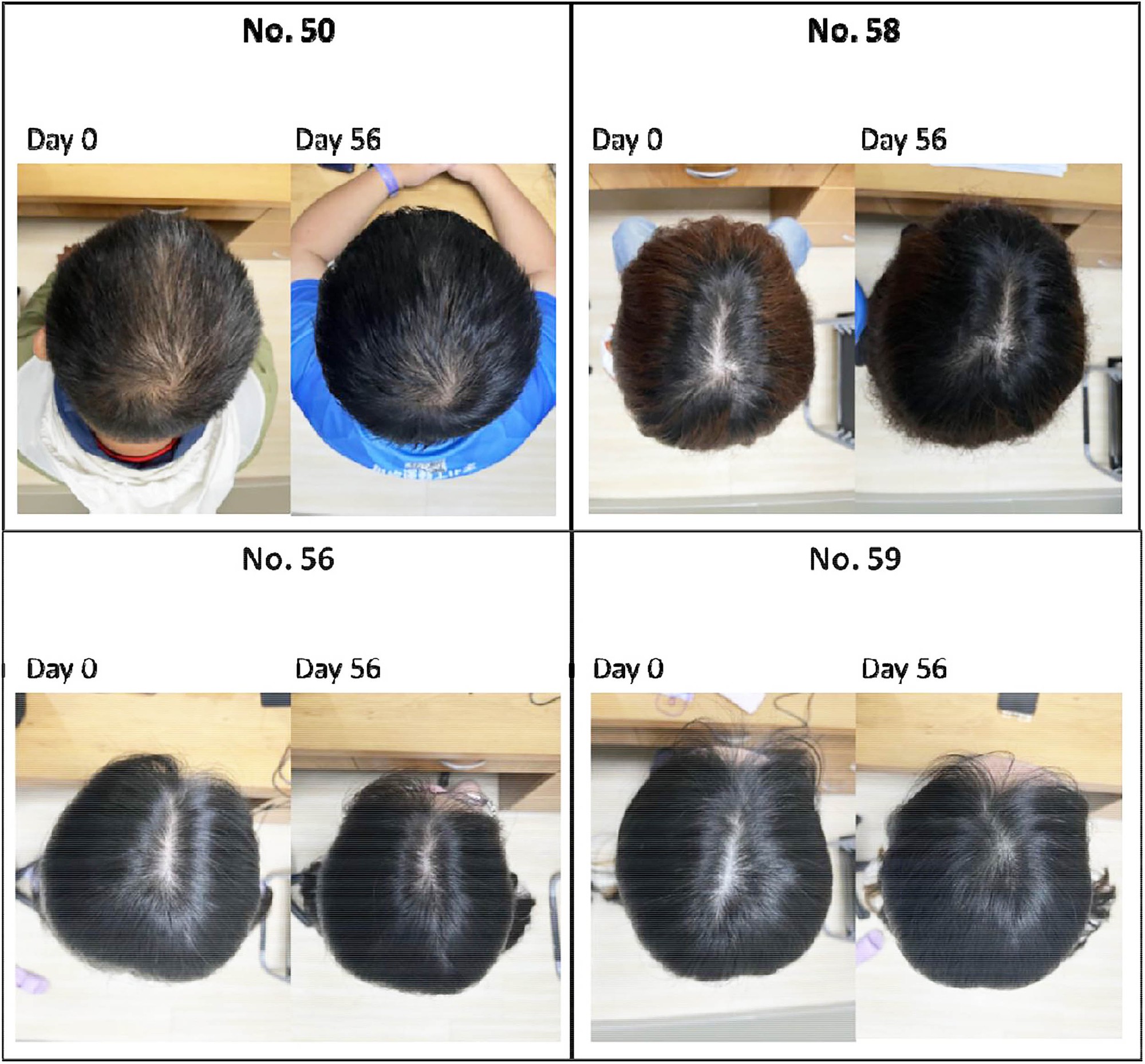 Bệnh h&oacute;i đầu sắp &rdquo;tuyệt chủng&rdquo; đến nơi: Huyết thanh từ thực vật gi&uacute;p t&oacute;c d&agrave;y l&ecirc;n 25% chỉ trong 56 ng&agrave;y - Ảnh 1.