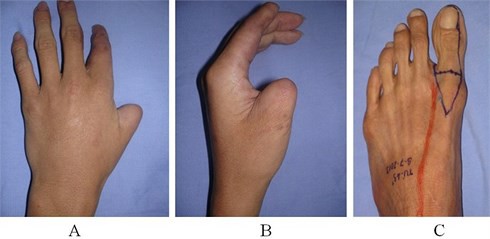Việt Nam vừa thực hiện thành công ca phẫu thuật siêu khó mang tầm quốc tế: thay ngón cái bằng ngón chân cái để phục hồi chức năng của bàn tay!  - Hình 12.