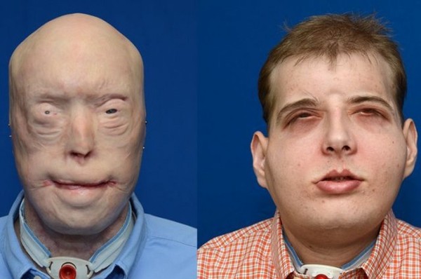  Patrick Hardison trước và sau khi phẫu thuật 
