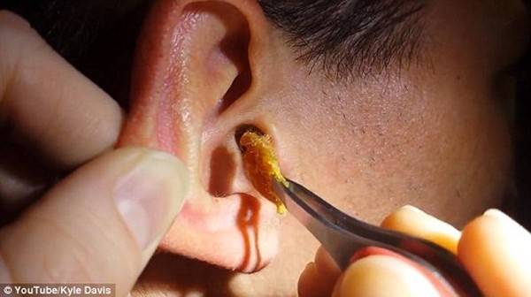  Theo quy luật tự nhiên, ráy tai sẽ từ từ thoát ra ngoài tai, cuốn theo mầm bệnh và tế bào chết. 